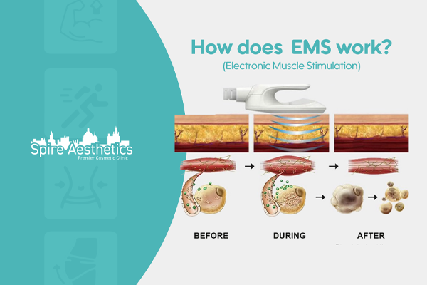 EMS treatment for post pregnancy weight loss treatment Hall Green