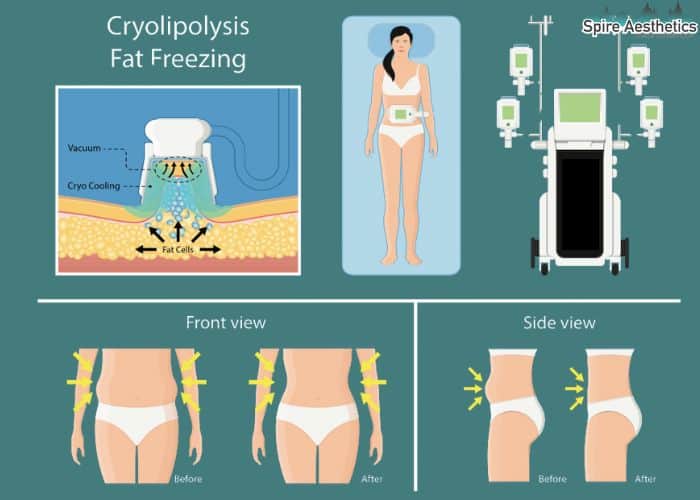 Image of diet and fat freezing combined for best results for Spire Aesthetics Hall Green