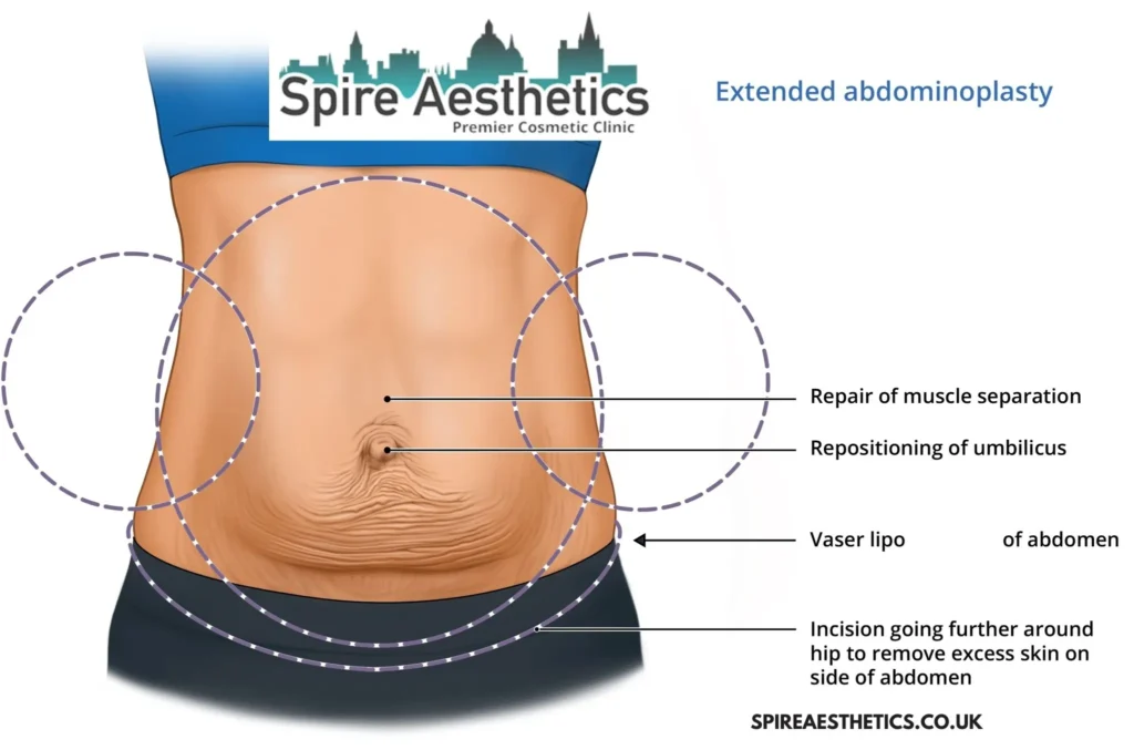 Understanding Loose Skin After Gastric Band Hall Green Surgery and HIFU Treatment
