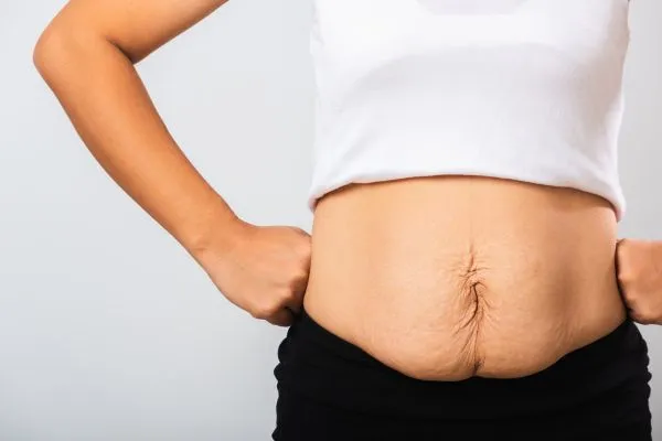Image of a woman's stomach after weight loss with sagging skin following a gastric band Hall Green