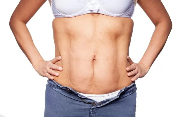 sagging skin on woman's stomach after weight loss injections Hall Green