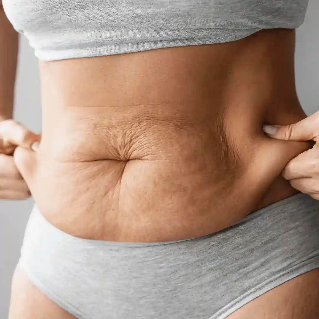 Is It Normal to Have Loose Skin After Pregnancy Hall Green?